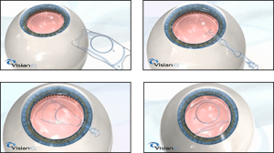 Lens Implant