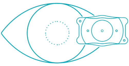 EVO ICL lens insertion