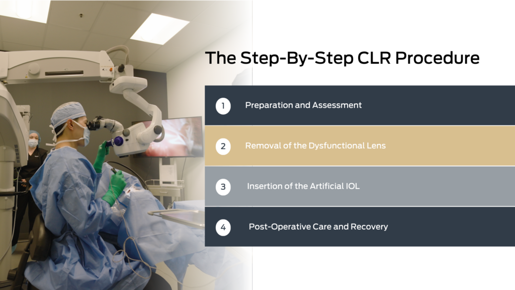 graphic showing the step-by-step process of CLR, from the removal of the dysfunctional lens to the insertion of the artificial IOL