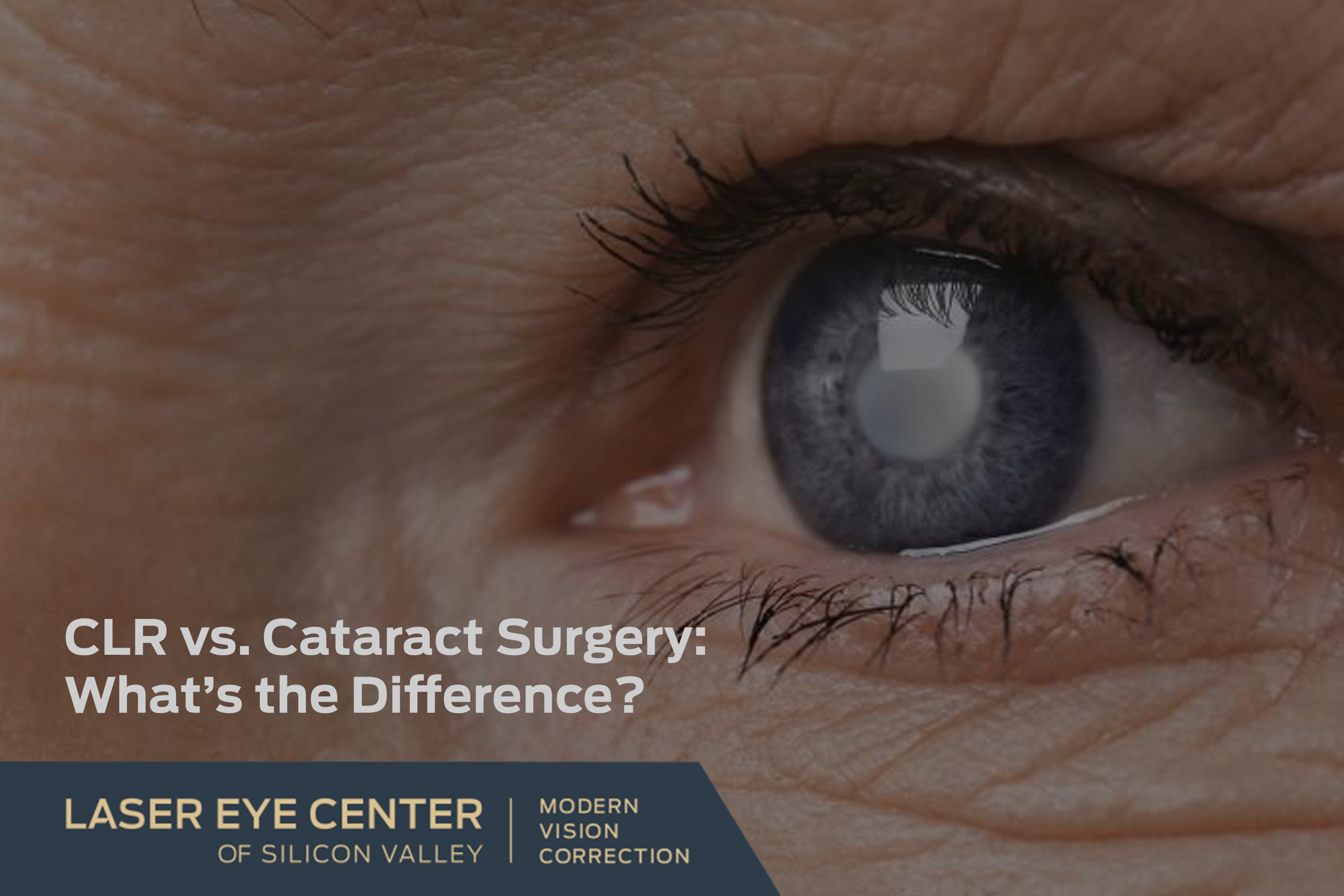 Close-up of blue eye for CLR vs. Cataract Surgery What’s the Difference blog
